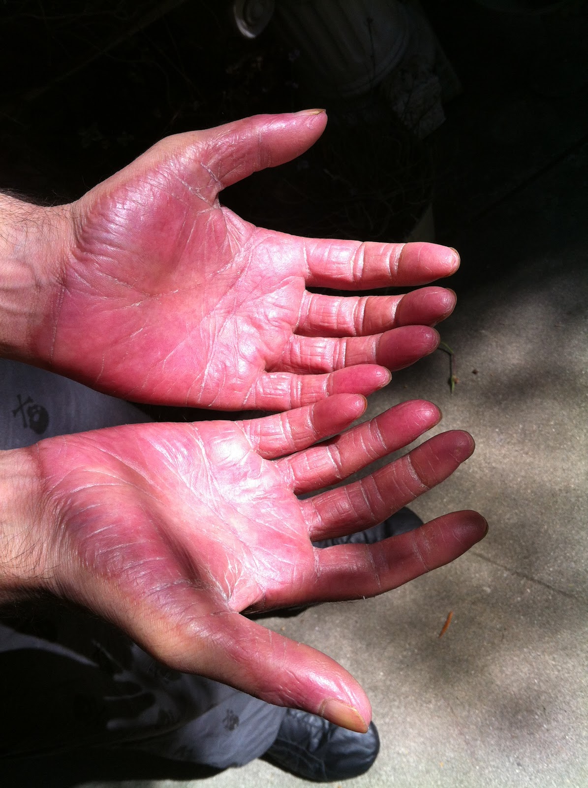 Cancer is a Cant purple hands and feet and chemo brain