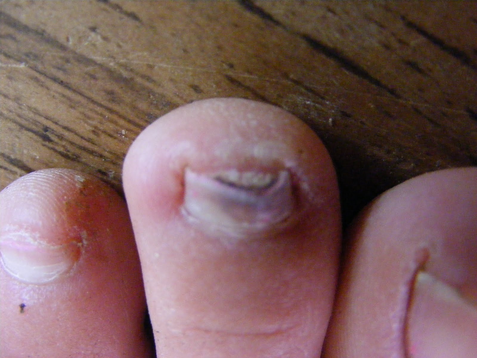 Disgusting Toenails