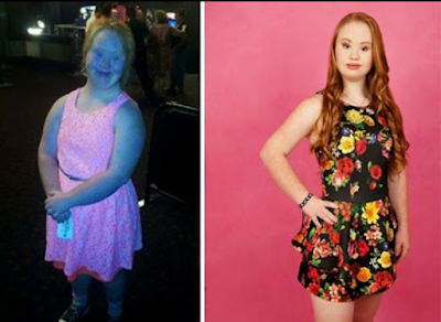 An Australian with Down Syndrome lost weight and became a model An Australian with Down Syndrome lost weight and became a model
