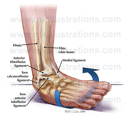 with the sprained ankle or