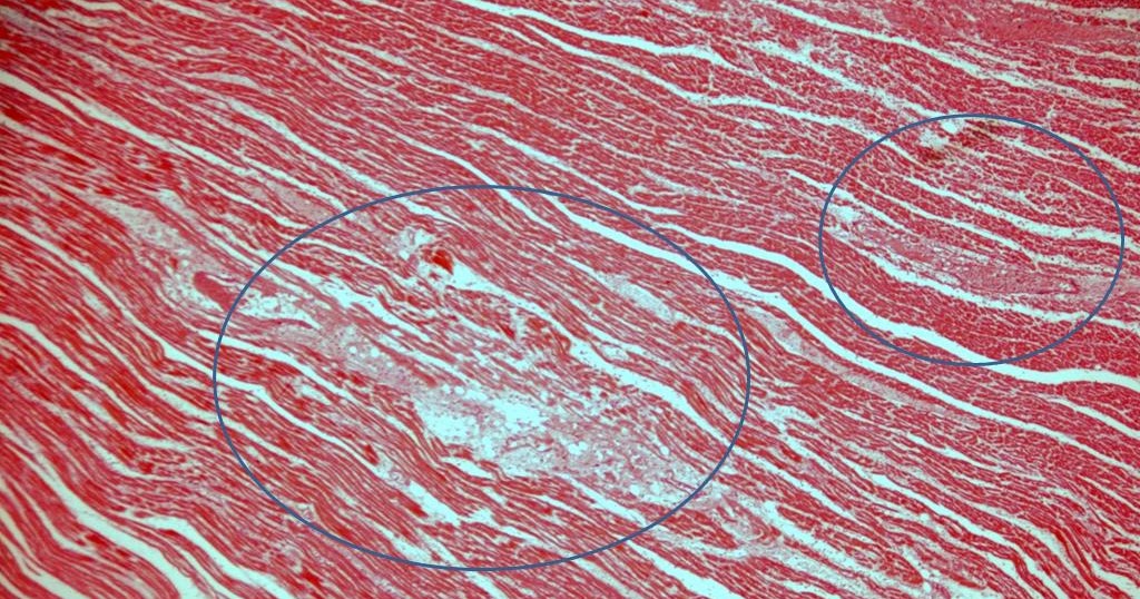 LAICI Laboratório de Investigação de Câncer e Inflamação Miocardite