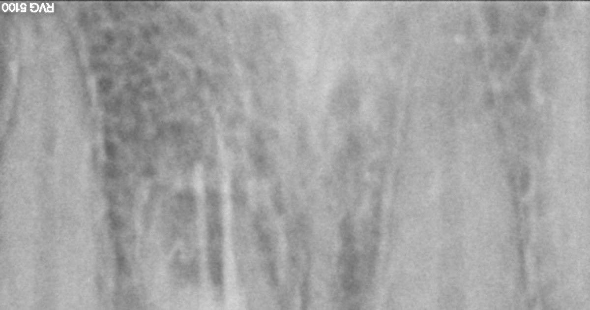 Endodontics Re rootcanal treatment with open apex central incisor