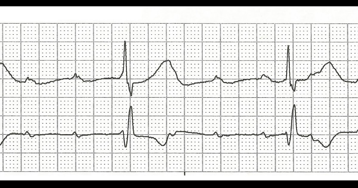 Float Nurse Practice EKG Rhythm Strips 155