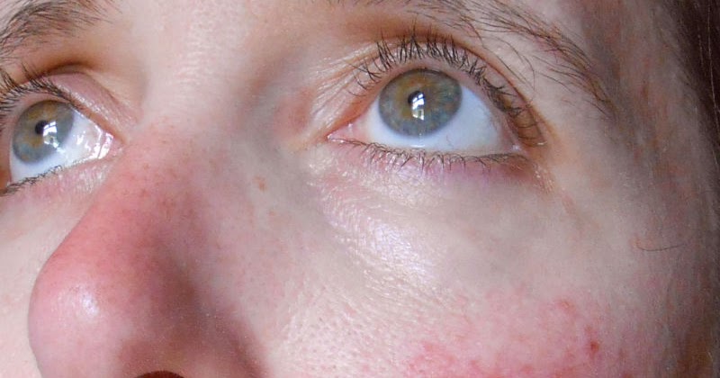 rosacea skin
