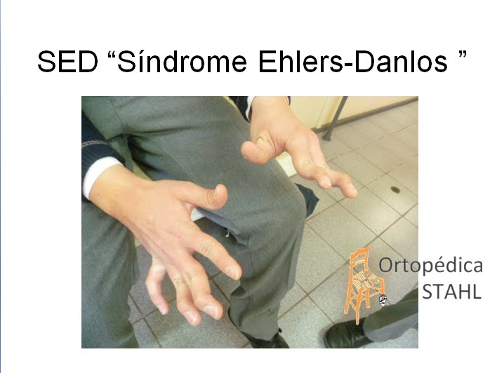 Hypermobility syndrome beighton ehlers danlos ehlersdanlos Sindrome de Ehlers - Danlos
