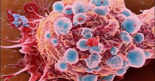 Cara mengobati penyakit kanker secara alami Pantangan