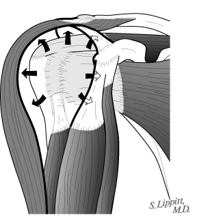 Shoulder Arthritis Rotator Cuff Tears Causes Of Shoulder Pain