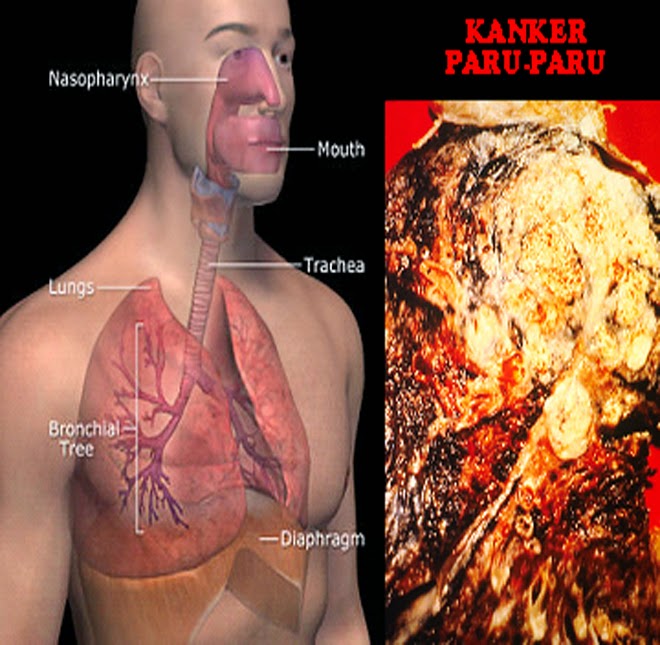 obat tumor Paru, obat kanker paru, pengobatan kanker paru