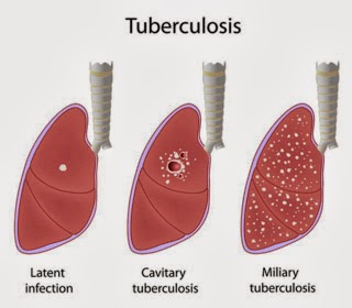 avery smithanatomy amrtutolo102414why is tuberculosis so Avery smithanatomy amrtutolo102414why is tuberculosis so avery smith anatomy a mrtutolo 10/24/14 why is tuberculosis so dangerous 1 what is tuberculosis and what. avery smithanatomy amrtutolo102414why is tuberculosis so Avery smithanatomy amrtutolo102414why is tuberculosis so avery smith anatomy a mrtutolo 10/24/14 why is tuberculosis so dangerous 1 what is tuberculosis and what.