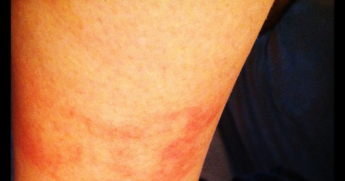 What's Wannietta Knitting Today? Sock Rash