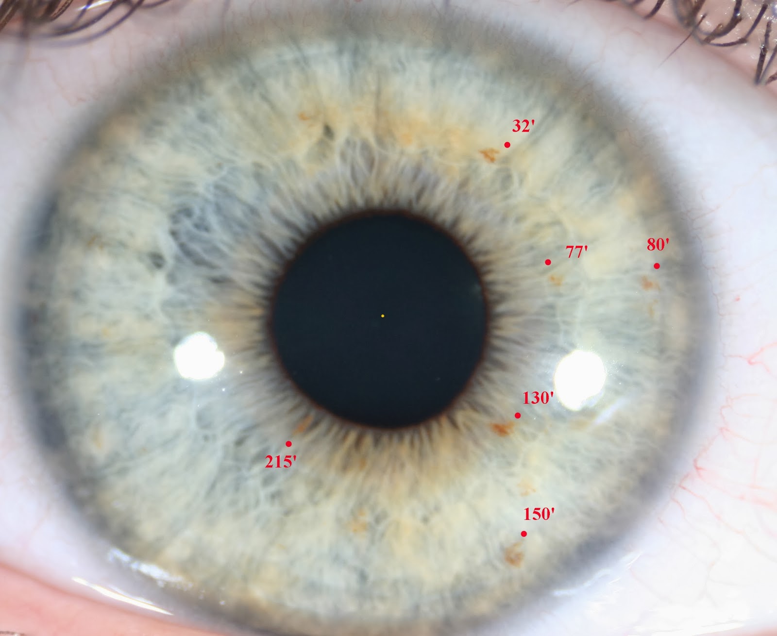Modern & Multidimensional Iridology Prioritize of Iris Pigments in