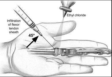 Trigger finger steroid injection technique