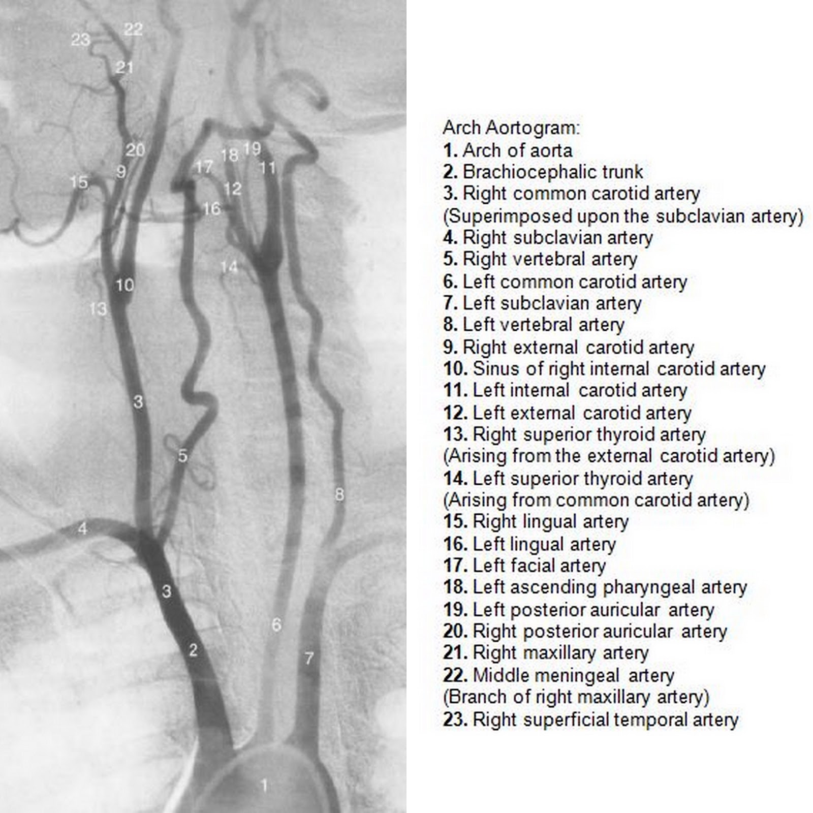 External Carotid Branches