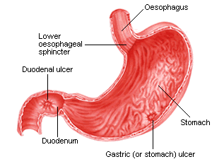 Gastric Ulcer Pictures
