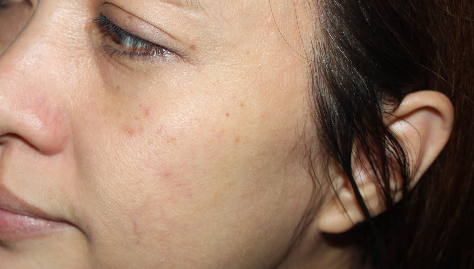 Allergic Reaction Caused By Fabric Softener at Ethel Blankenship blog