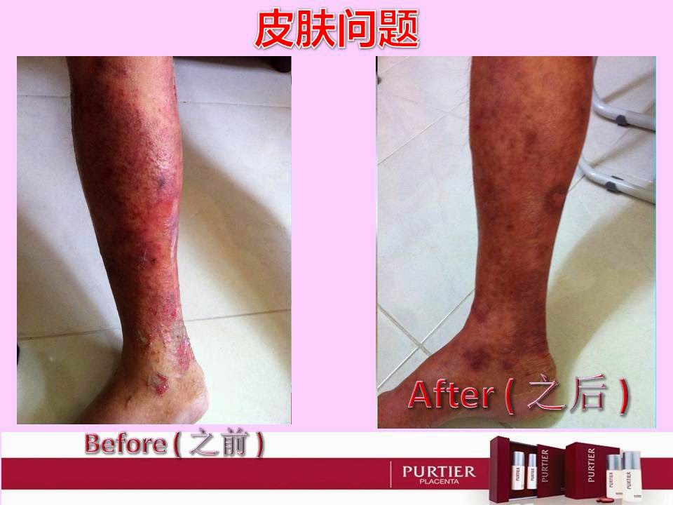 SKIN DISEASE (PSORIASIS/ACZEMA/CUTANEOUS CONDITION)