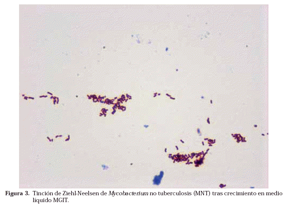 DIAGNOSTICO DE MYCOBACTERIUM TUBERCULOSIS diagnostico de mycobacterium tuberculosis:
