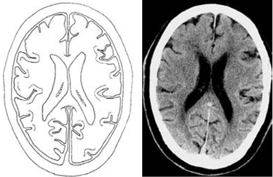head ct radiopaedia