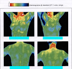 Thermoregulatory dysfunction following ETS (T2) for plamar HH