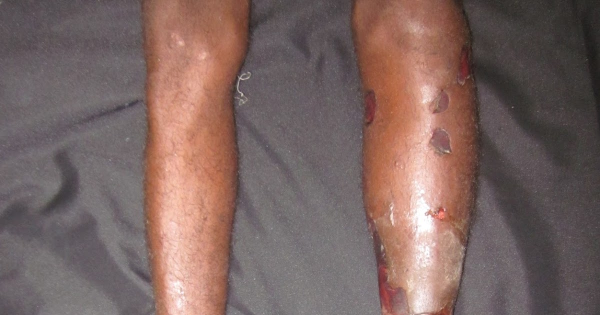 BURN INJURY , HAND BURNS, ELECTRICAL BURNS. HIGH VOLTAGE ELECTRICAL