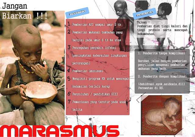 TEMBANG: Leaflet &quot;Marasmus&quot;