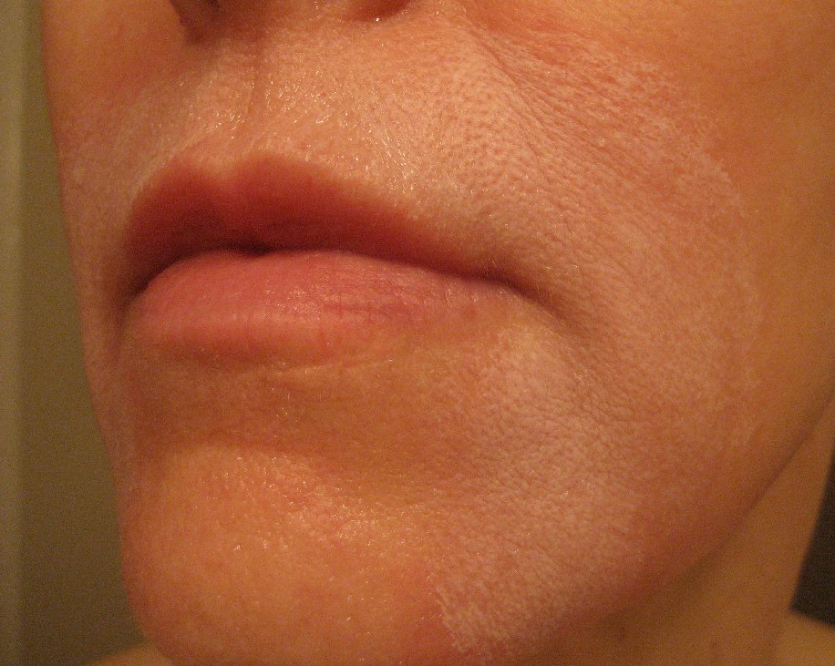 Chemical Peels for Acne and Anti Aging 5th TCA Chemical Peel day 4