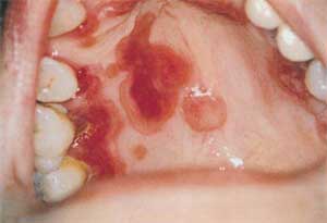 Quick Question - Syphilis Chancre on Mouth (5 replies): Is a Syphilis chancre on  the mouth usually on the lips o.[more] · 300980_tn?