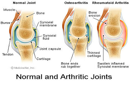 8 Facts about Arthritis Fact File