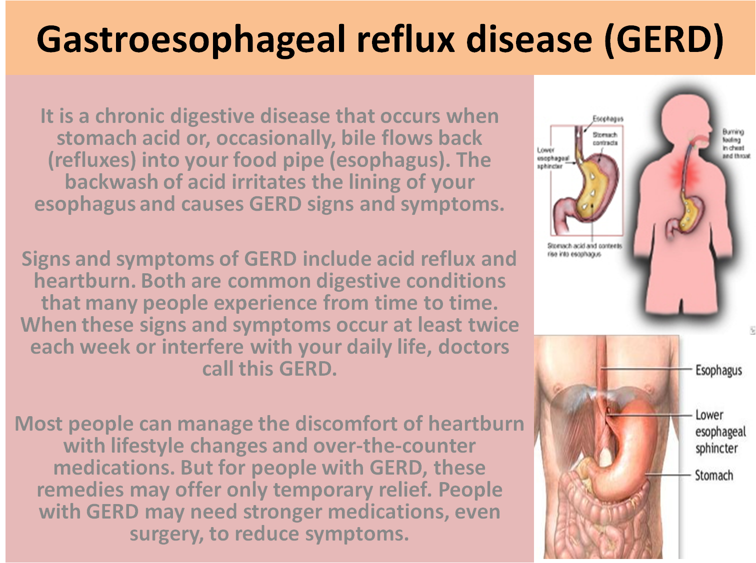 acid reflux disease Gastroesophageal reflux disease (gerd) is a more serious and long-lasting form of ger and may prevent an infant from feeding symptoms & causes. acid reflux disease Gastroesophageal reflux disease (gerd) is a more serious and long-lasting form of ger and may prevent an infant from feeding symptoms & causes.
