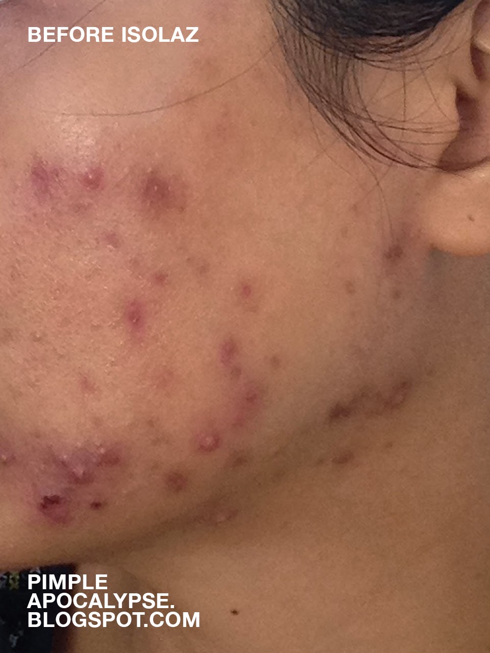Pimple Apocalypse My Experience With Isolaz And Laser Genesis