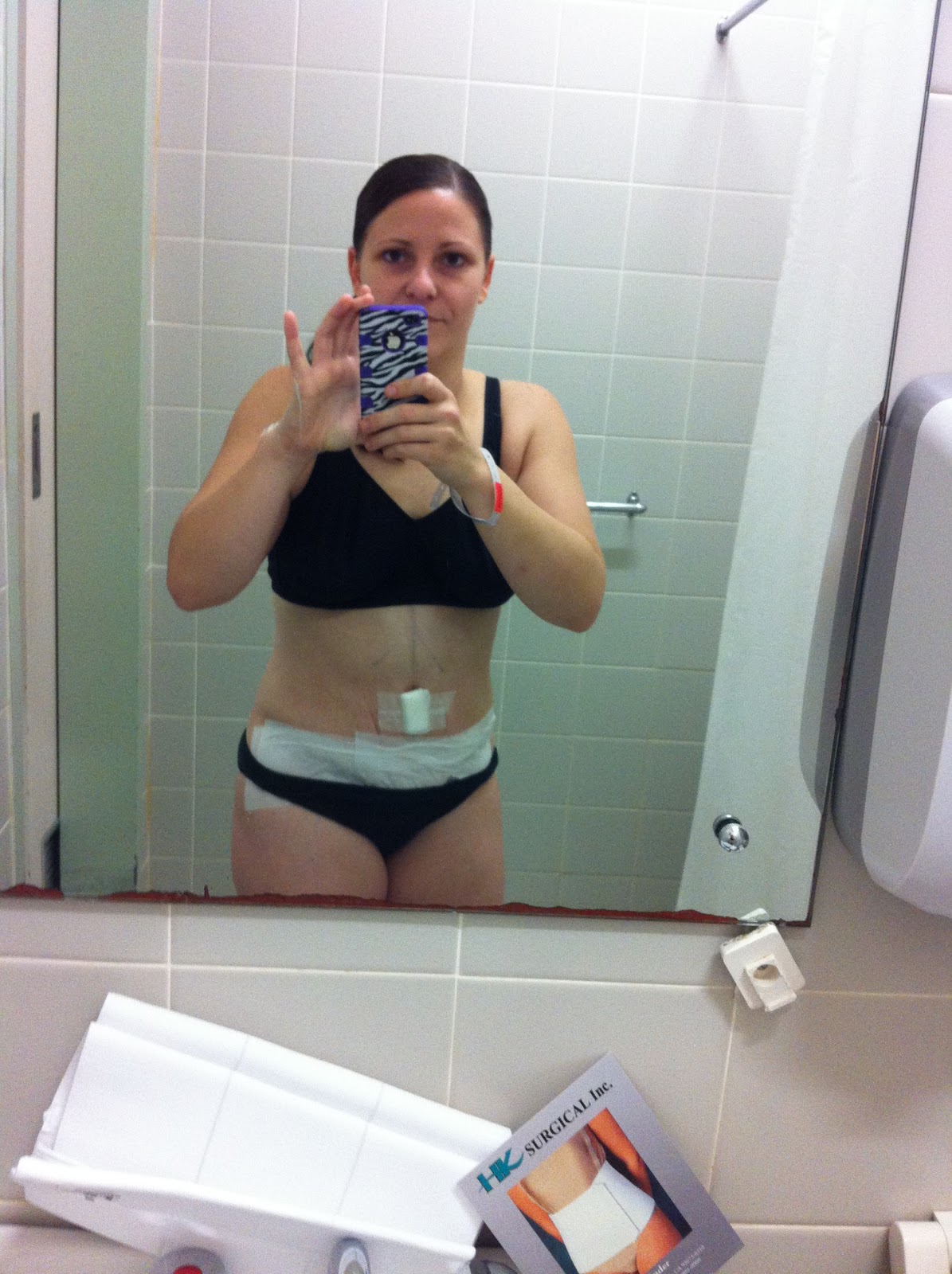 tummy tuck op before tape abdominoplasty own its