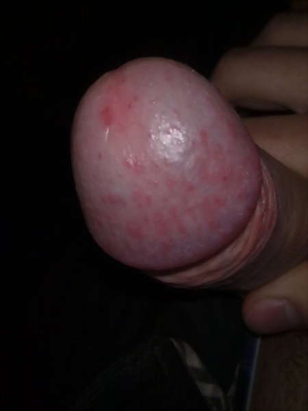 image of pictures of herpes on penis