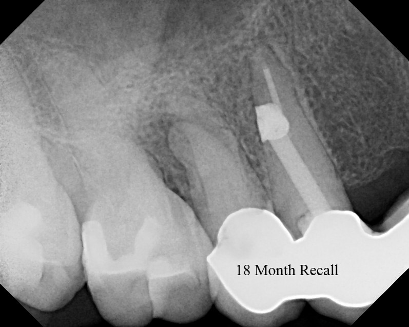 The Endo Blog Root Canal Surgery to Repair Post Perforation