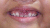 Central Incisors