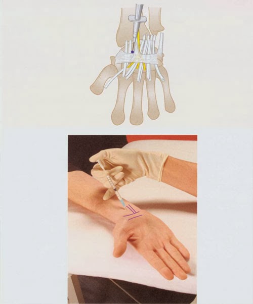 Carpal Tunnel Injection Nursing