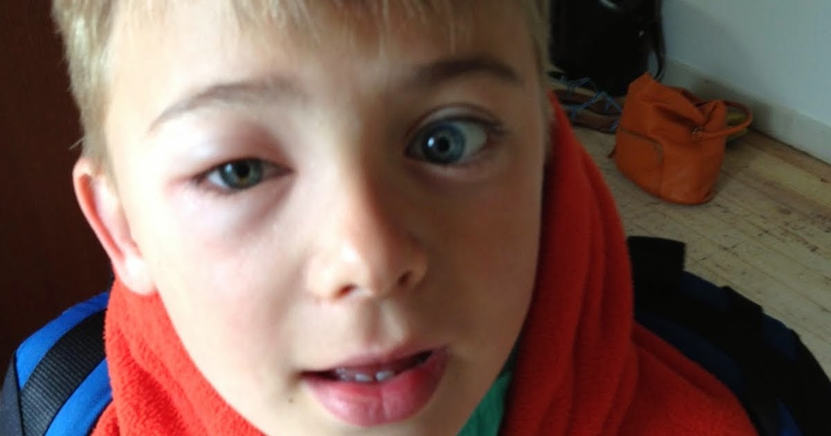William's little world: Insect bite under the eye yesterday.