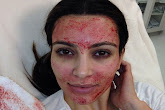 Kim Kardashian se inyecta su propia sangre en el rostro para ser más bella
