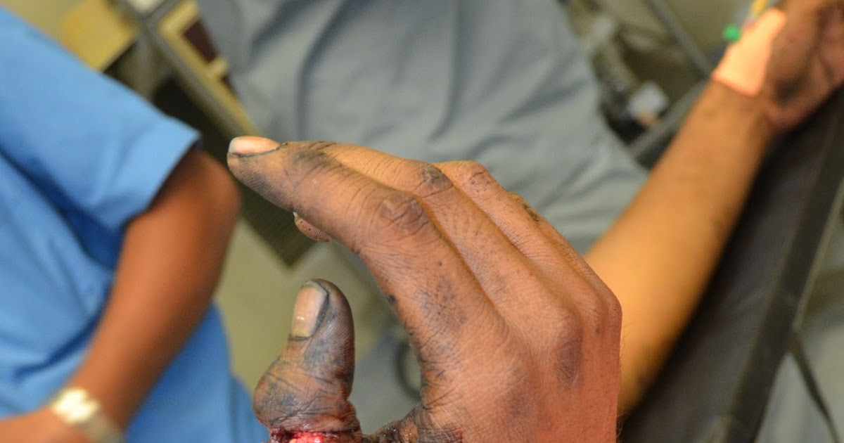 CRUSH INJURIES OF HAND AND UPPER LIMB INJURIES SUB TOTAL AMPUTATION