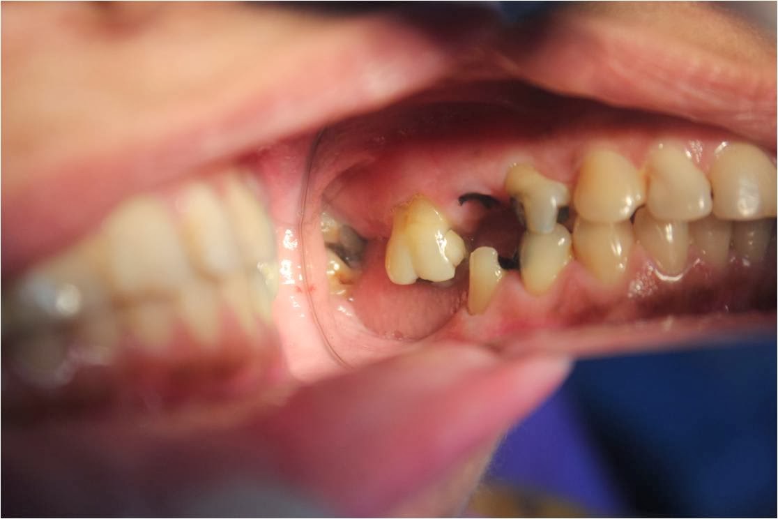 Upper and lower molars replacement optionsWithout sinus lift in the