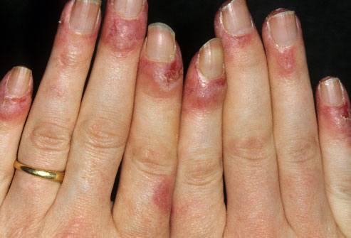 Lupus can cause the nails to crack or fall off. They may be discolored with