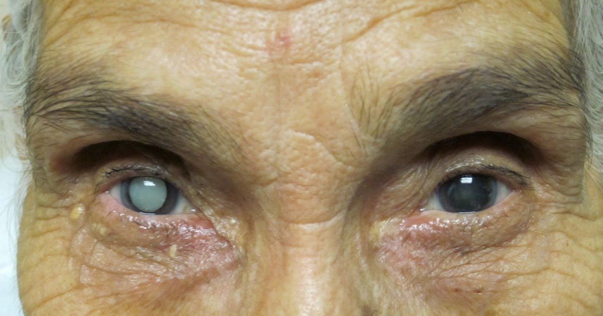 Before and After Cataract OperationsBefore and AfterBefore and After