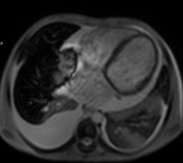Myocardial Iron EstimationMRI Sumer's Radiology Blog