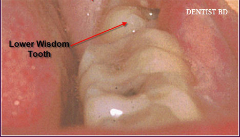 Wisdom Teeth Cysts