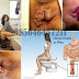 Pengobatan Ambeien (Hemoroid) di Klinik Herbal thumbnail