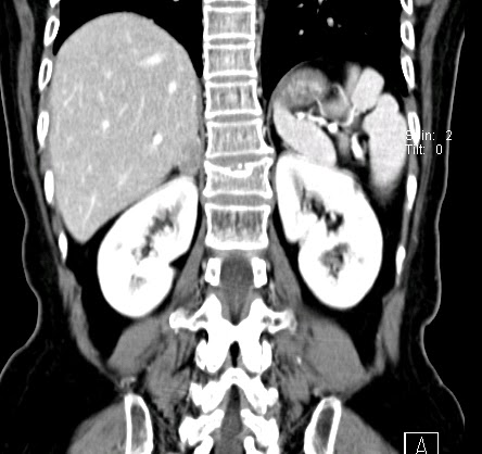 adrenal washout ct radiopaedia
