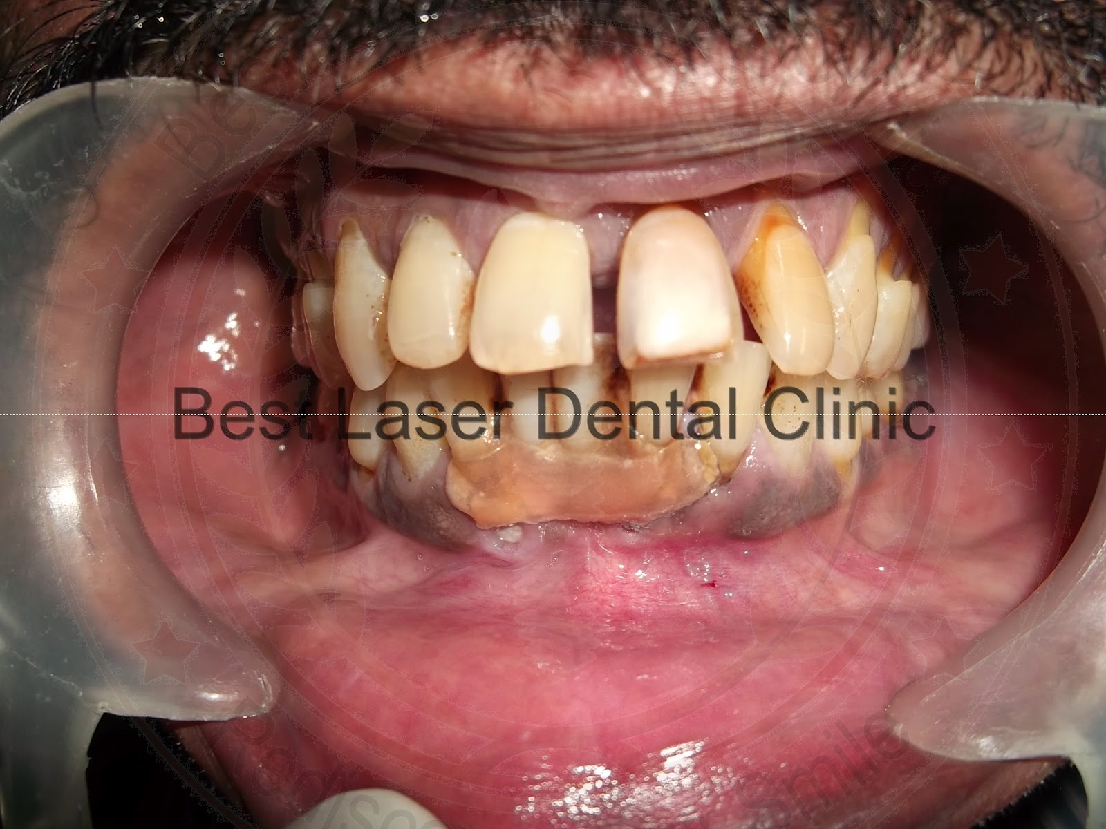 Brand new teeth by bicortical dental implants (How to strengthen the