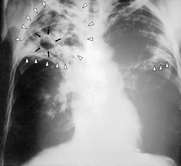 Tuberculosis Health and Disease