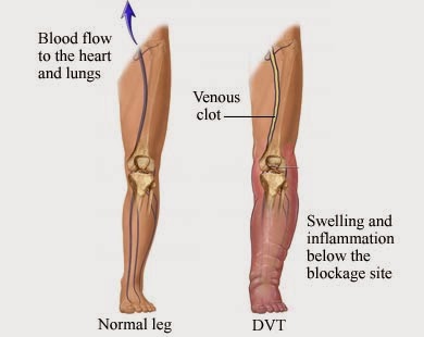 ICD 9 Code For Dvt