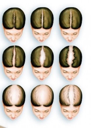 Abnormal Hair Loss Causes And Solutions Curlynikki Natural