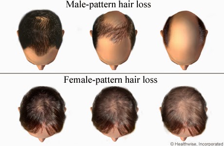 Types of Hair Loss | ArganRain Ultra Nourishing Hair and ...